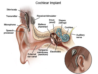 Cochlnear Implant